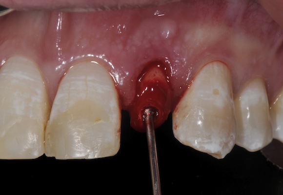 Avoid costly and time consuming procedures